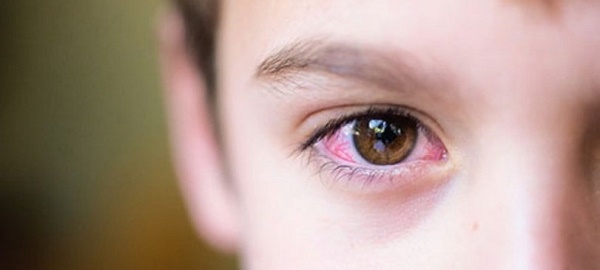 Đau mắt đỏ cũng là một trong những triệu chứng của Covid 19
