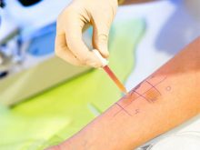 dị ứng vaccine covid19