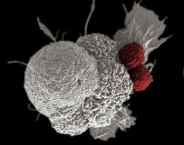 tế bào ung thư dưới kính hiển vi