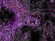 tế bào ung thư dưới kính hiển vi