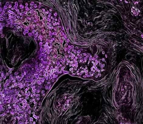 tế bào ung thư dưới kính hiển vi