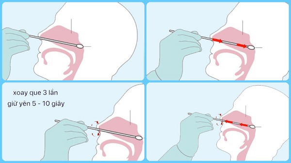 Lấy mẫu dịch tỵ hầu